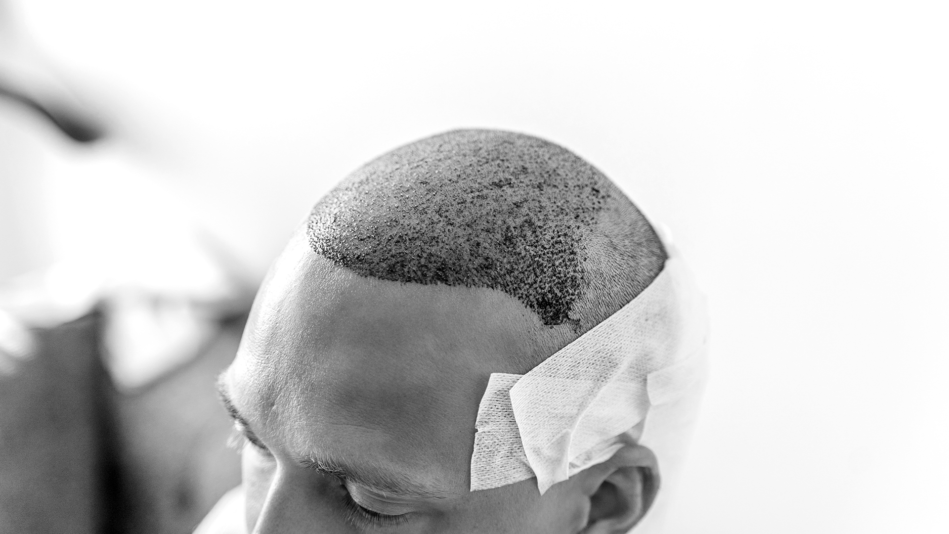 what-to-expect-after-hair-transplantation-hed-clinic